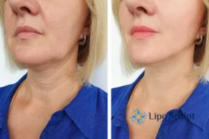 Double chin before and after Hi-Fu treatment 4 Book your double chin treatment Merseyside today! We are here to help!