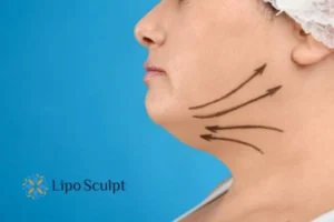 Double chin before and after Hi-Fu treatment 3 Boost your confidence with a Double chin treatment Merseyside