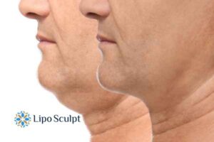 Double chin before and after Hi-Fu treatment 2 Double chin treatment Merseyside from Lipo Sculpt - feel more confident today!