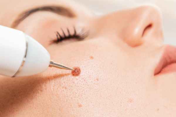 CryoPen: 5 Skin Concerns It May Be Used to Treat 3 What actually happens during a CryoPen treatment Merseyside?