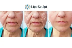 Explaining Morpheus8 And What It Can Do For You 3 Boost your confidence with Morpheus8 Merseyside call our team today!